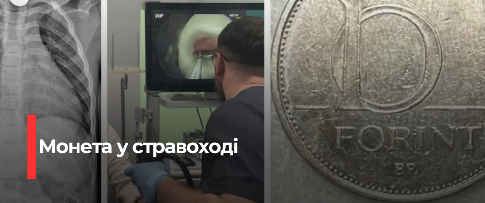 Рівненські лікарі витягли з стравоходу угорську монету, яку проковтнула дитина