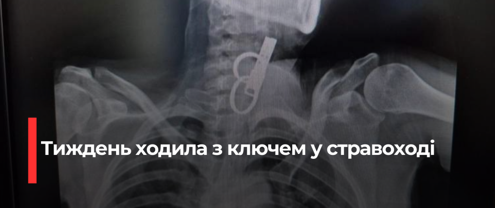 Лікарі Унікально Витягли Ключ З Пацієнтки На Тернопільщині
