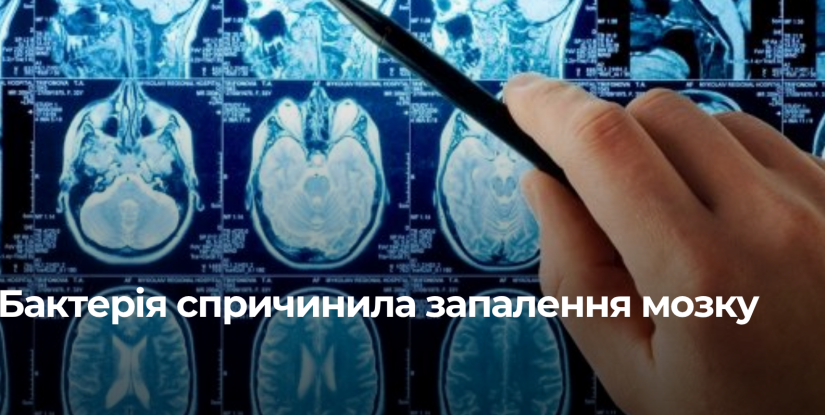 Виявлення лістеріозу на Рівненщині: симптоми та профілактика